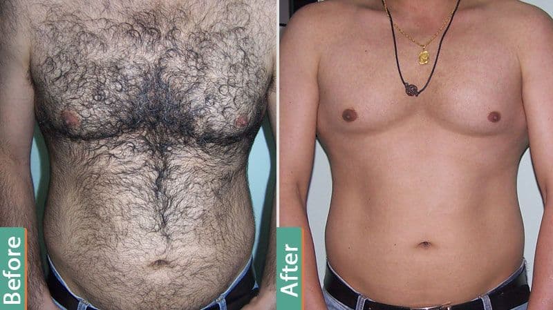 Prime Laser Hair Removal Center Katy